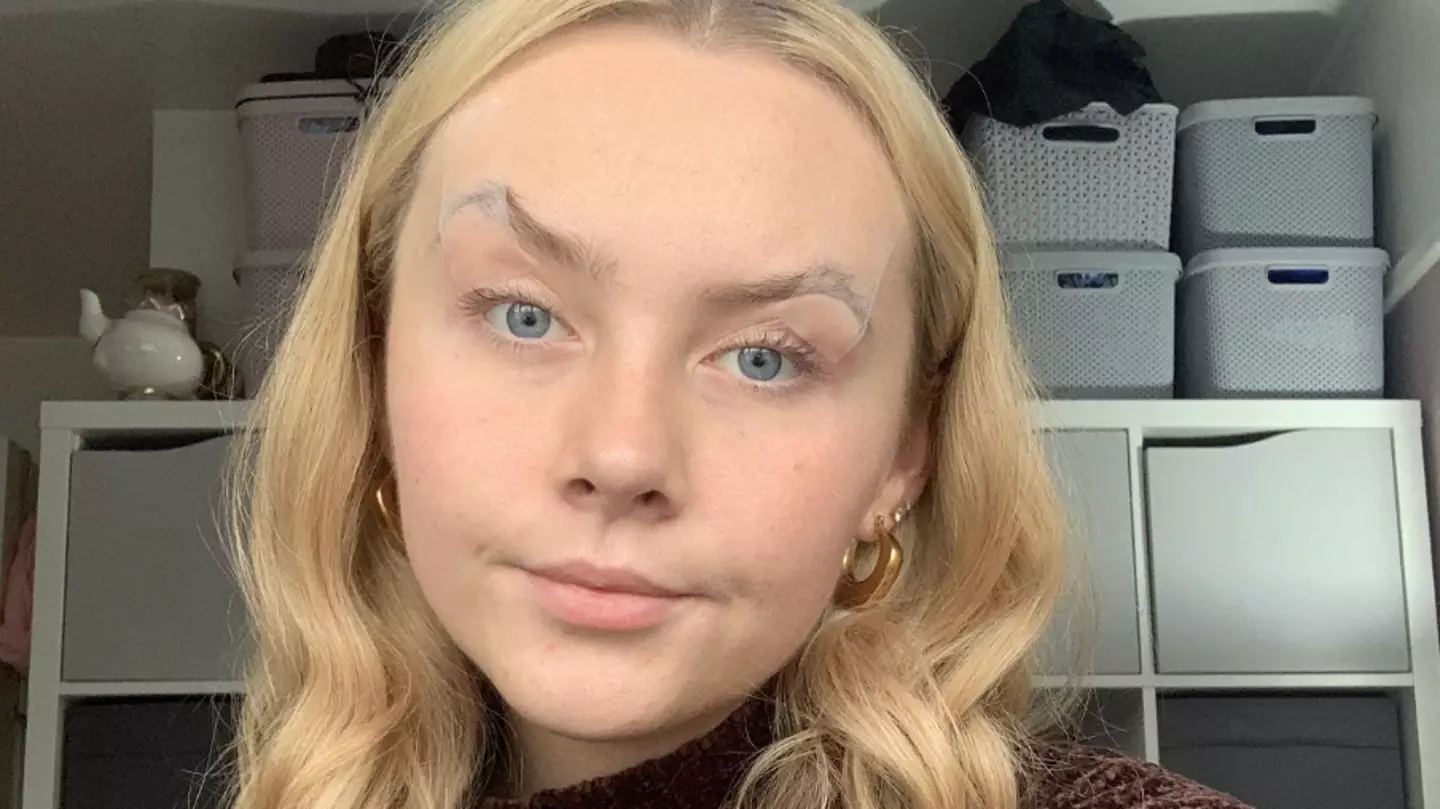 Woman has to tape or glue eyes open just to see due to bizarre condition
