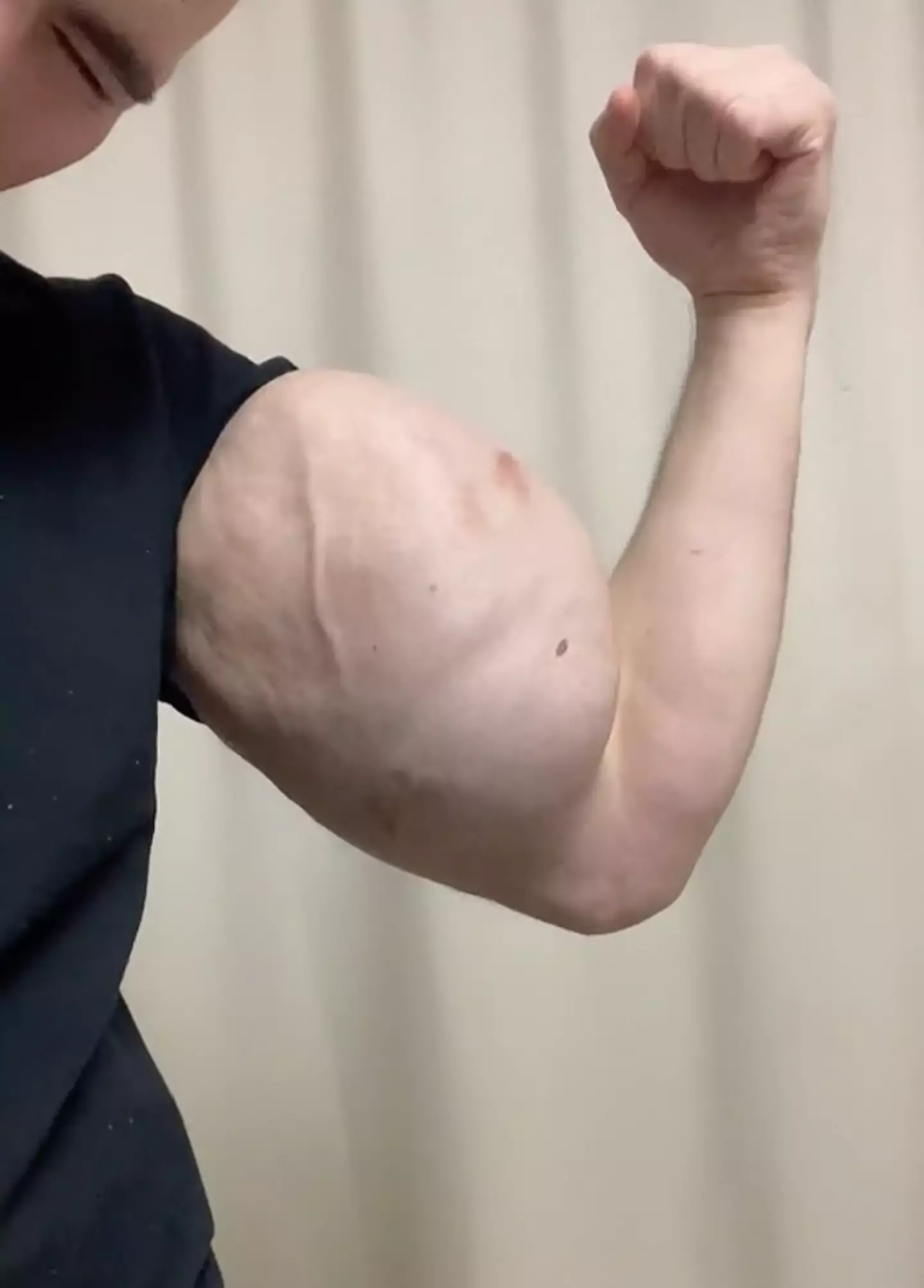 'Russian Popeye' faces more operations in the future.