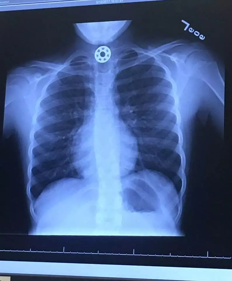 Fidget spinner stuck in child's throat