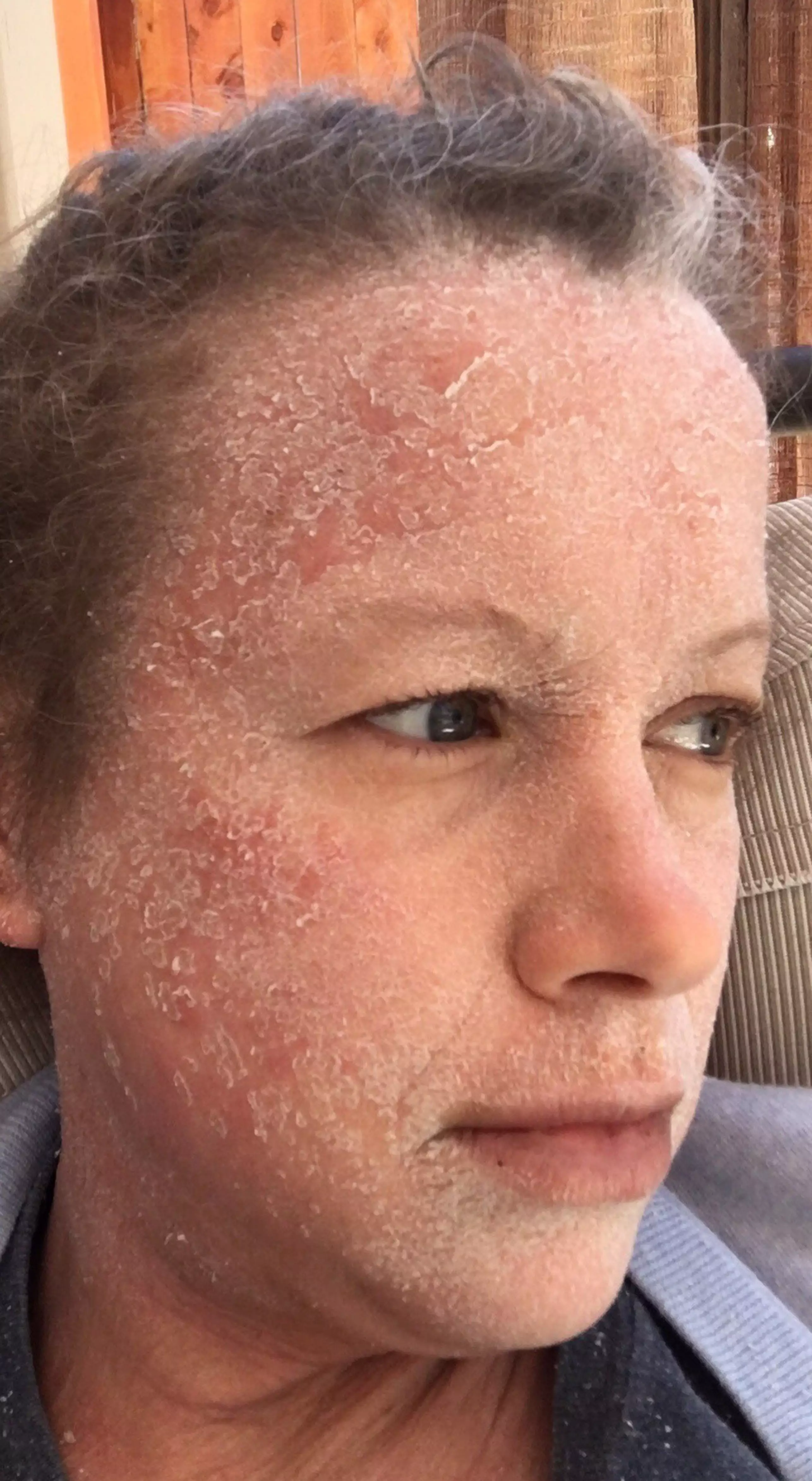 Jennifer Pierce went into withdrawal when she stopped using steroid cream to treat her eczema (