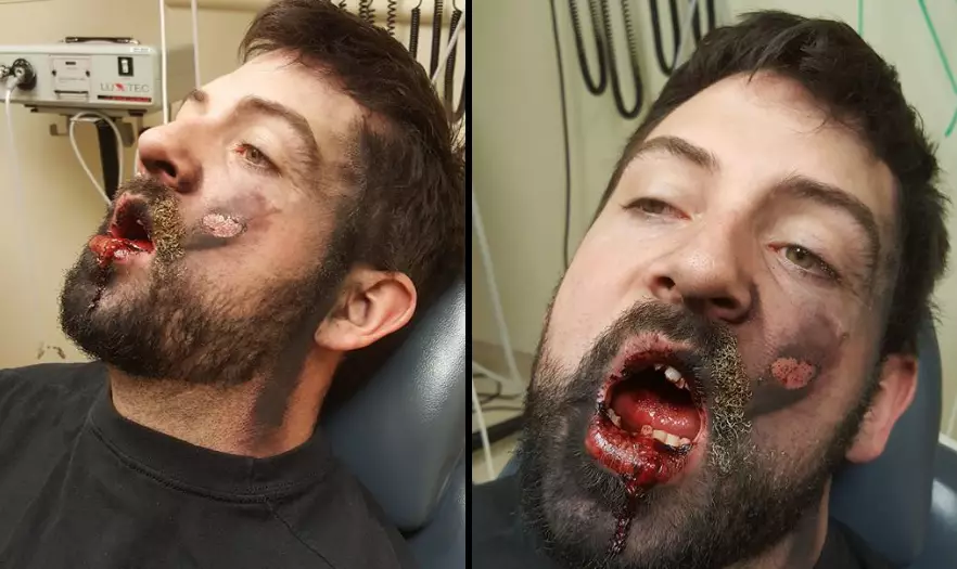 Man Warns Of Dangers Of Vaping After His E-Cigarette Explodes