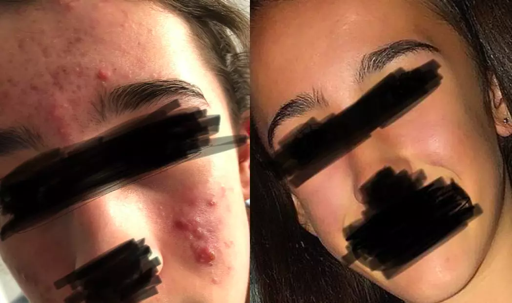 One woman, whose daughter struggled with acne, used Acnecide 5% Gel Benzoyl Peroxide with amazing results.