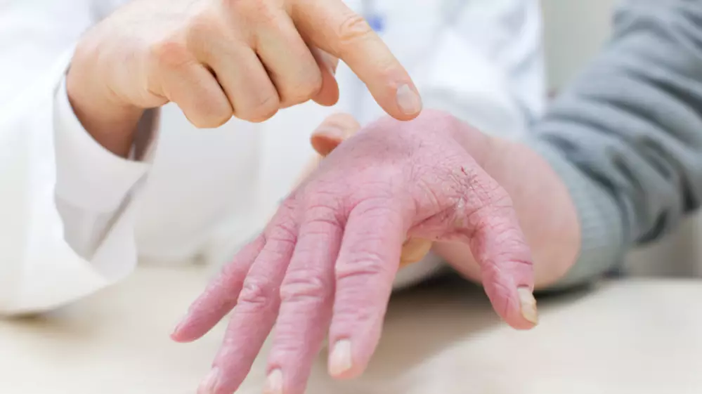 Doctor Explains Why Eczema Gets Worse At This Time Of Year