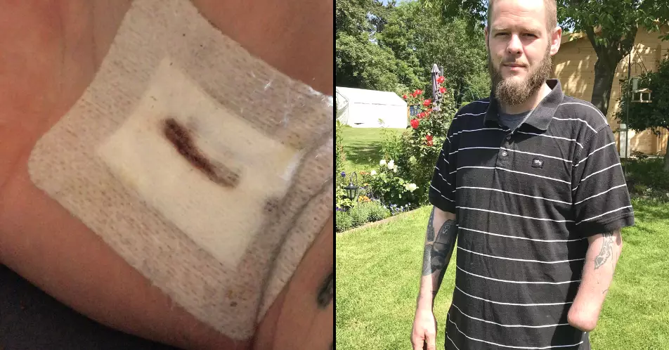 Man Has Hand Amputated After Getting Tiny Scratch From Household Chores