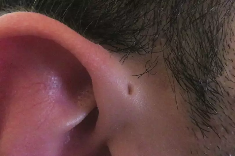 If You Have This Tiny Hole Above Your Ear There Is Actually A Reason