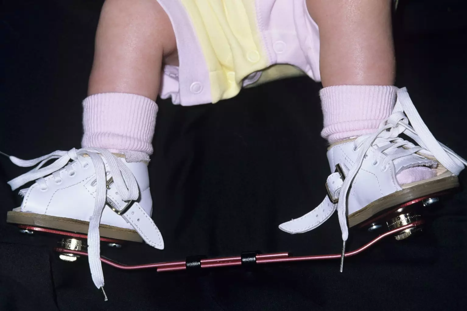 'Your baby will need to wear special boots attached to each other with a bar to prevent the club foot returning.' (
