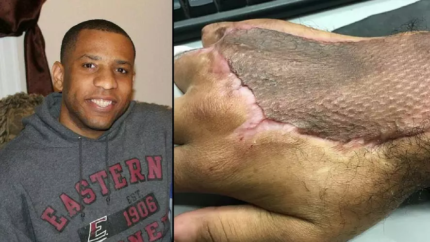 Bloke Contracted 'Flesh-Eating' Bacteria After Cracking His Knuckles