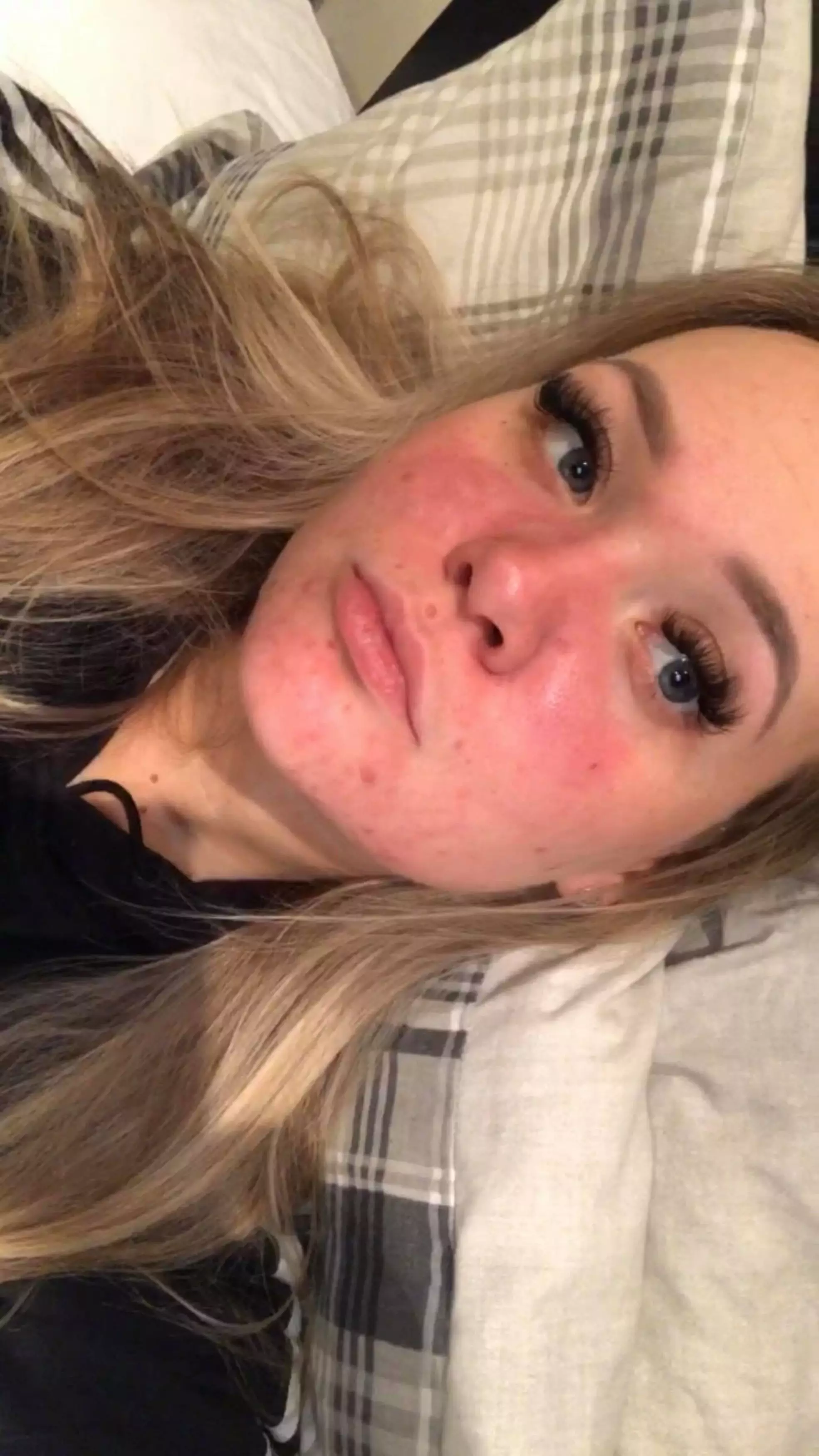 Ellie started a six month treatment on roaccutane in October 2019 (