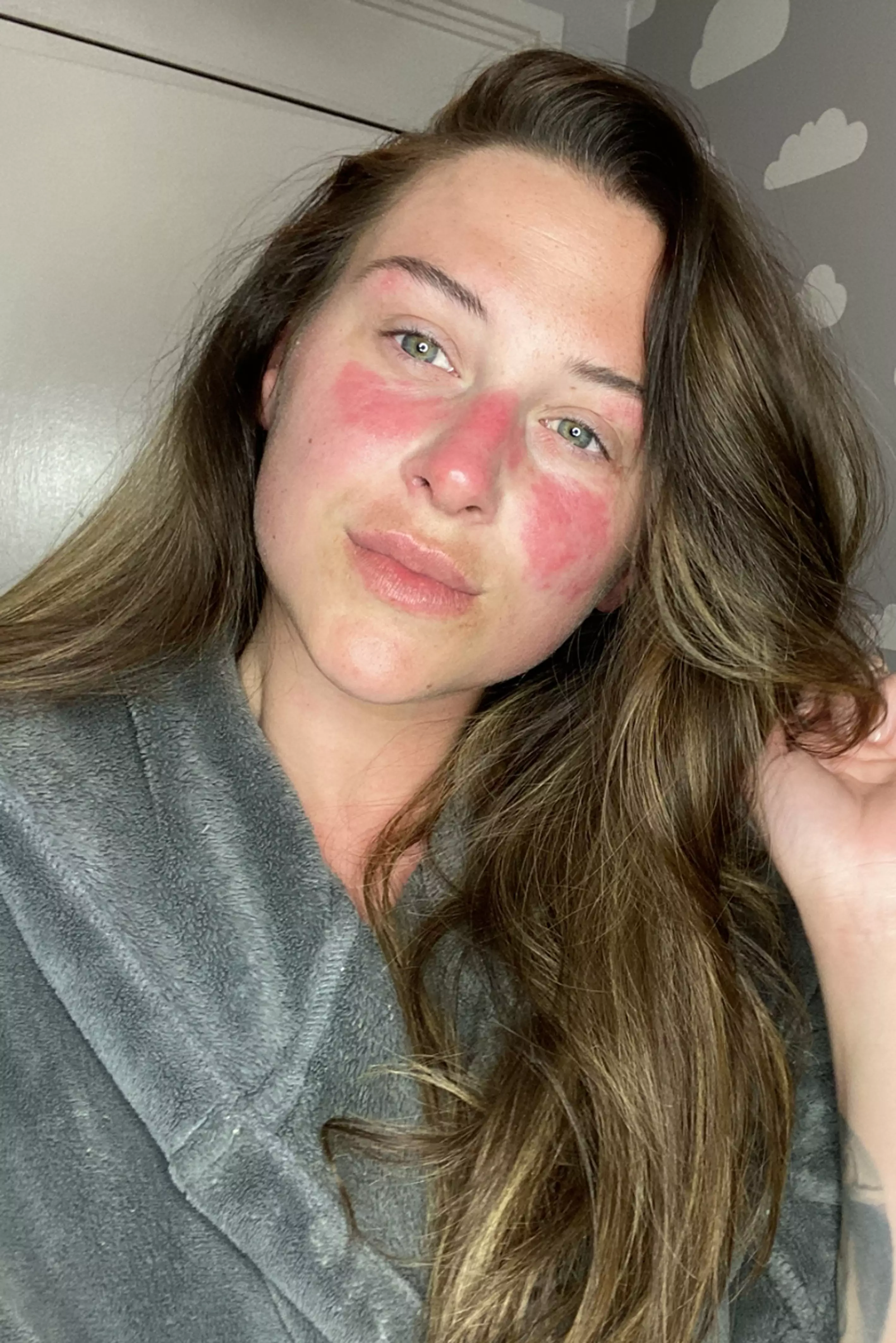 Lauren revealed that she used to feel insecure about the red patches on her face after bullies called her 'snake skin' (