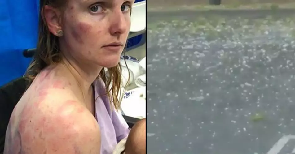 Mum Reveals Her Bruised Body After Shielding Her Baby From Huge Hailstones