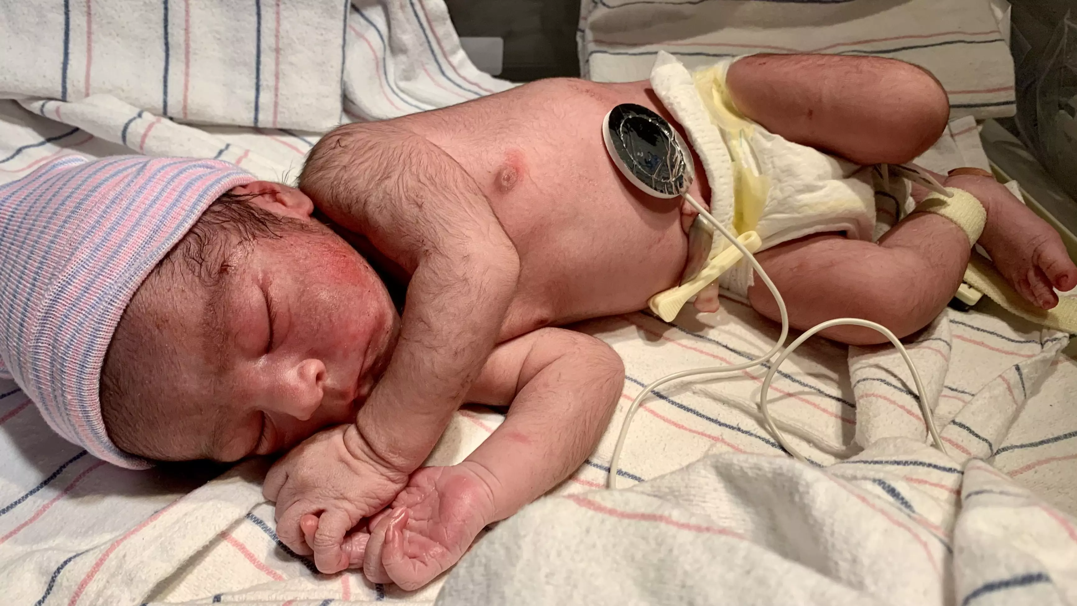 Parents Shocked As 'Mini Wolverine' Baby Born Covered In Hair