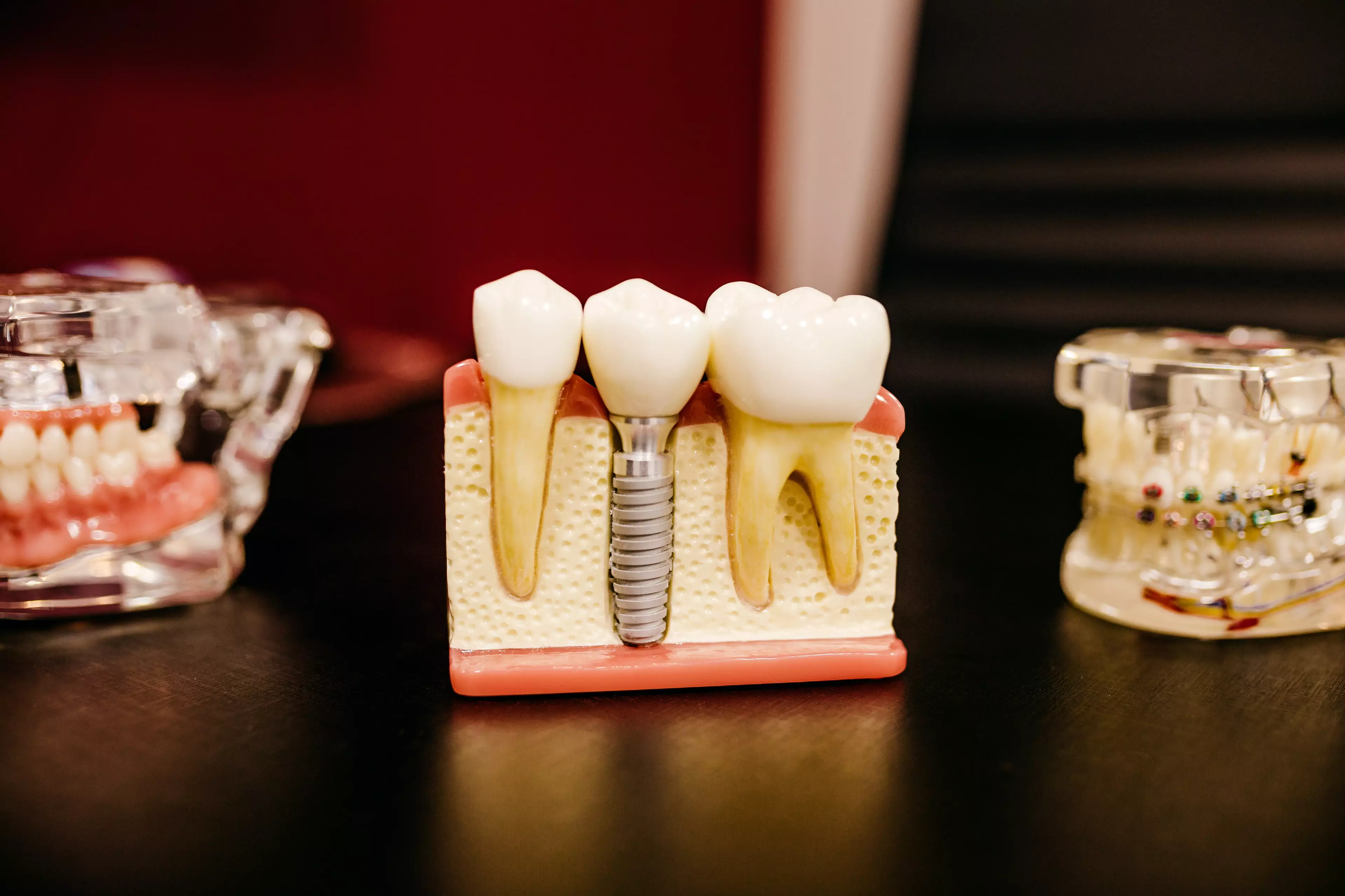 Wisdom teeth are the final set of teeth to emerge in early adulthood (