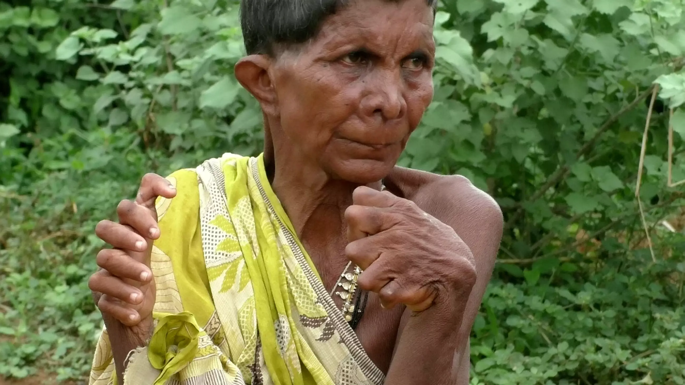 Woman Born With 20 Toes And 12 Fingers Says People Think She's A Witch
