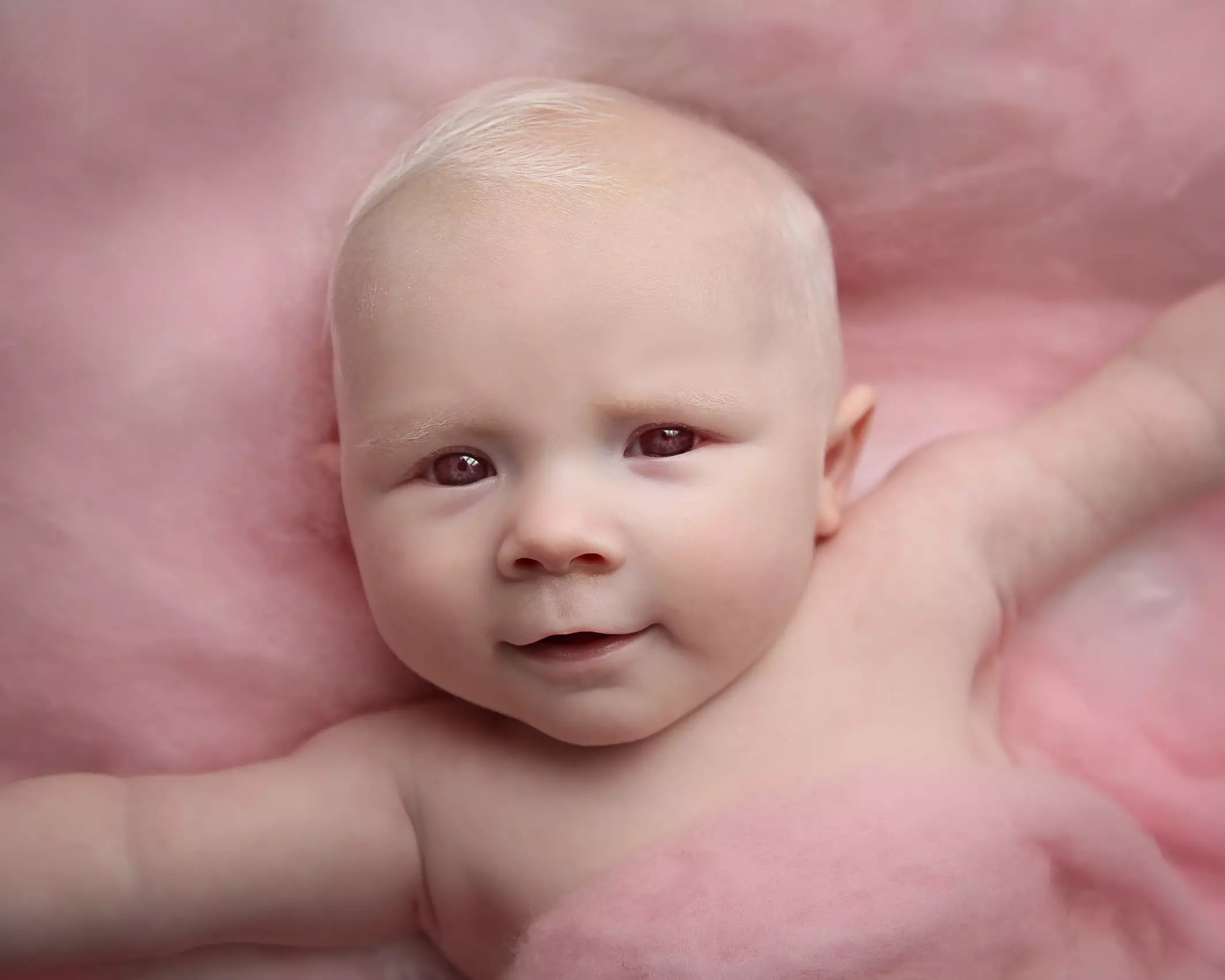 Baby Ava was born with Albinism.