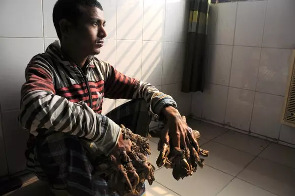 'Tree Man' Cured After 16 Operations To Fix His Hands