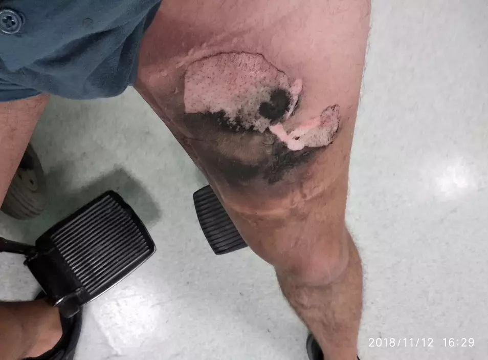 The e-cigarette device burst into flames leaving the man with burns to his thigh and genitals.