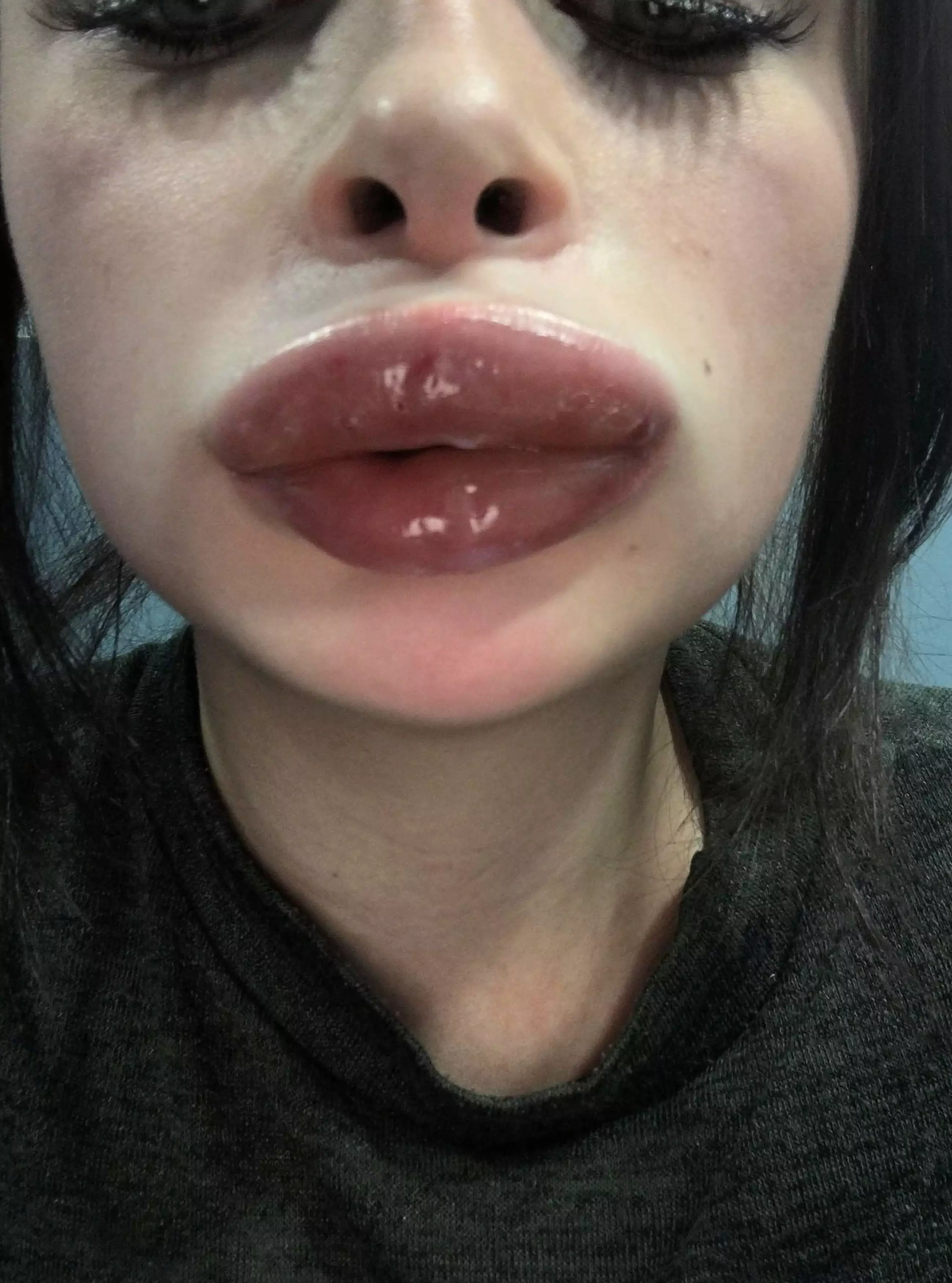 The young mum wants to warn people about the dangers of lip fillers.