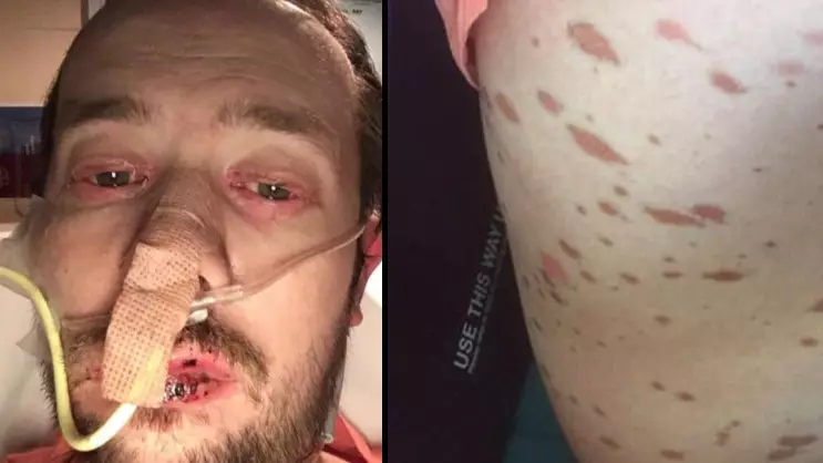 Man Ends Up In Hospital For A Month After Dismissing Rare Condition As Flu 