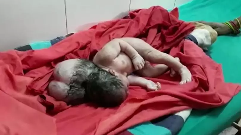 Baby Baffles Doctors After Being Born With 'Three Heads'