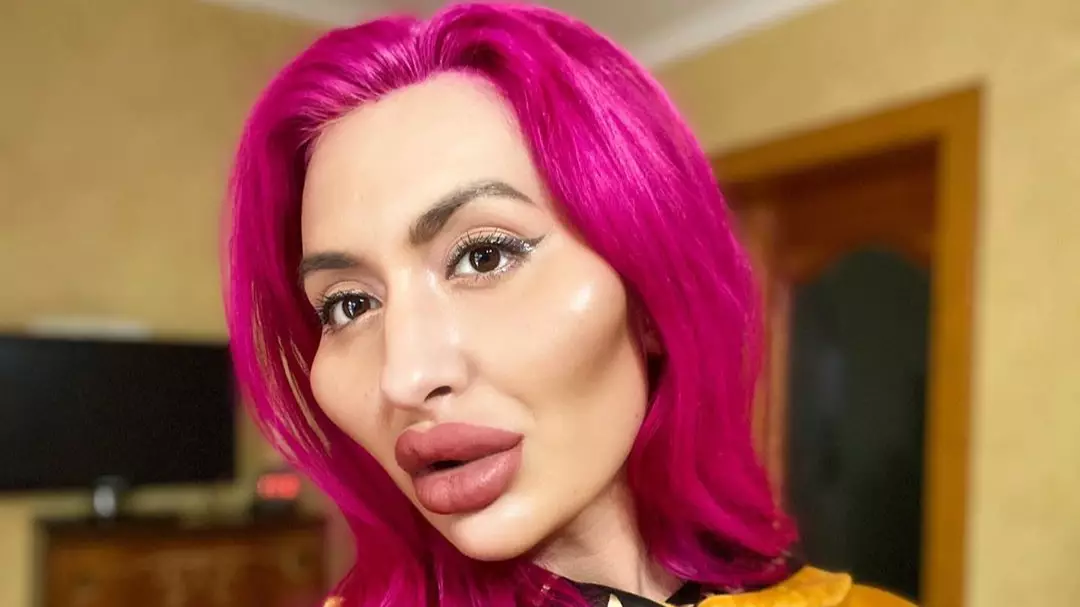 Woman Loves Cheek Fillers So Much She Even Injects Them Herself 