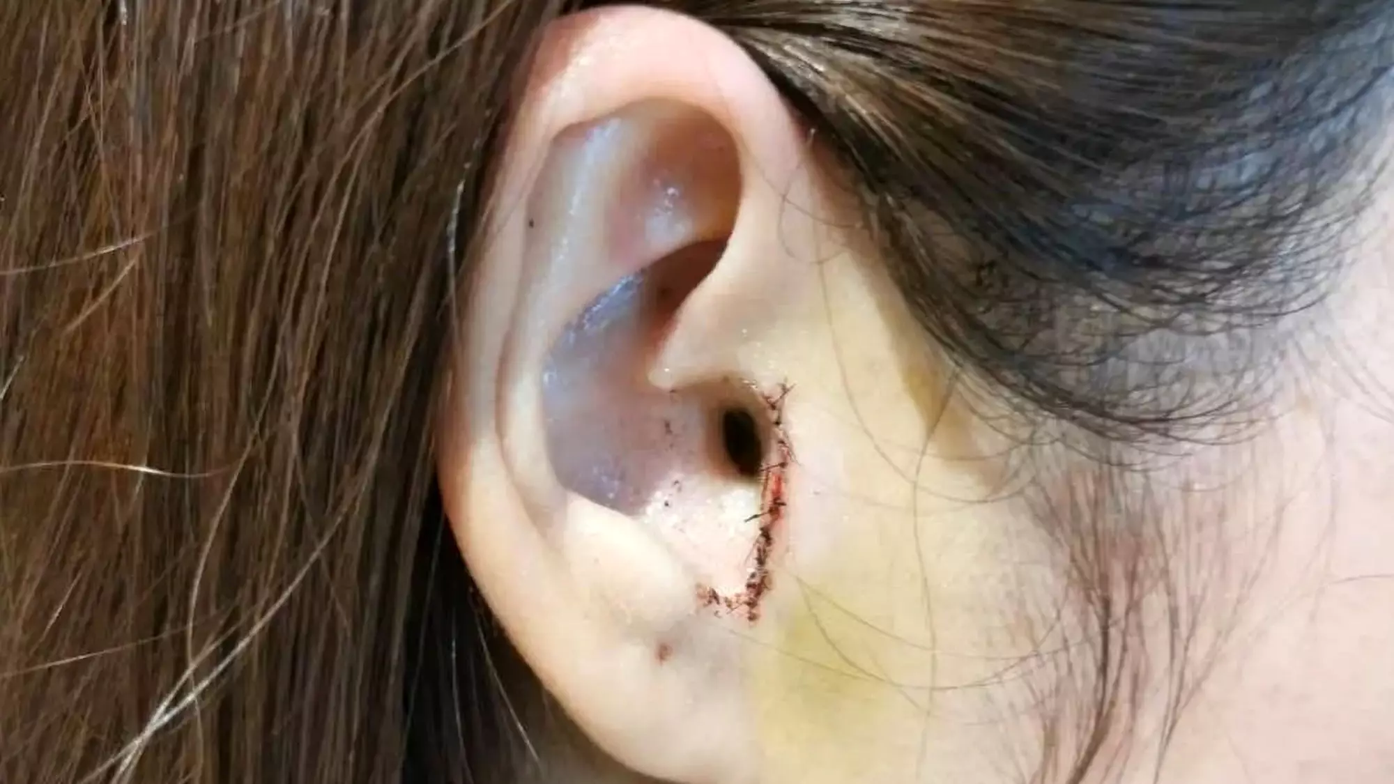 Woman Unknowingly Has Part Of Her Ear Removed During Nose Job Surgery