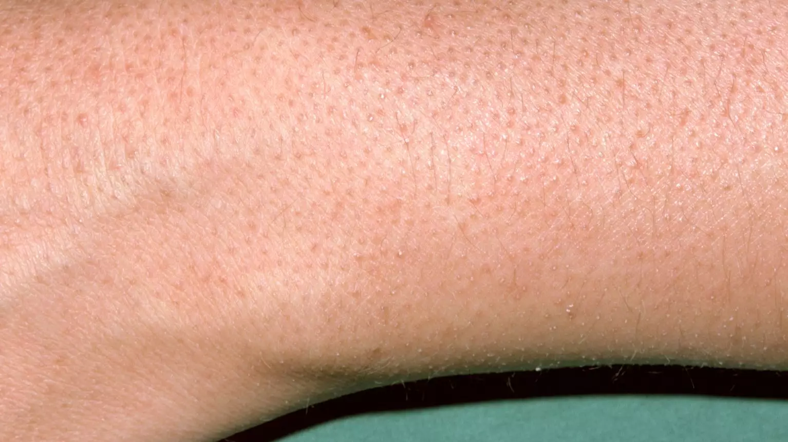 TikTok Doctor Explains What The 'Weird Red Bumps' On People's Arms Are