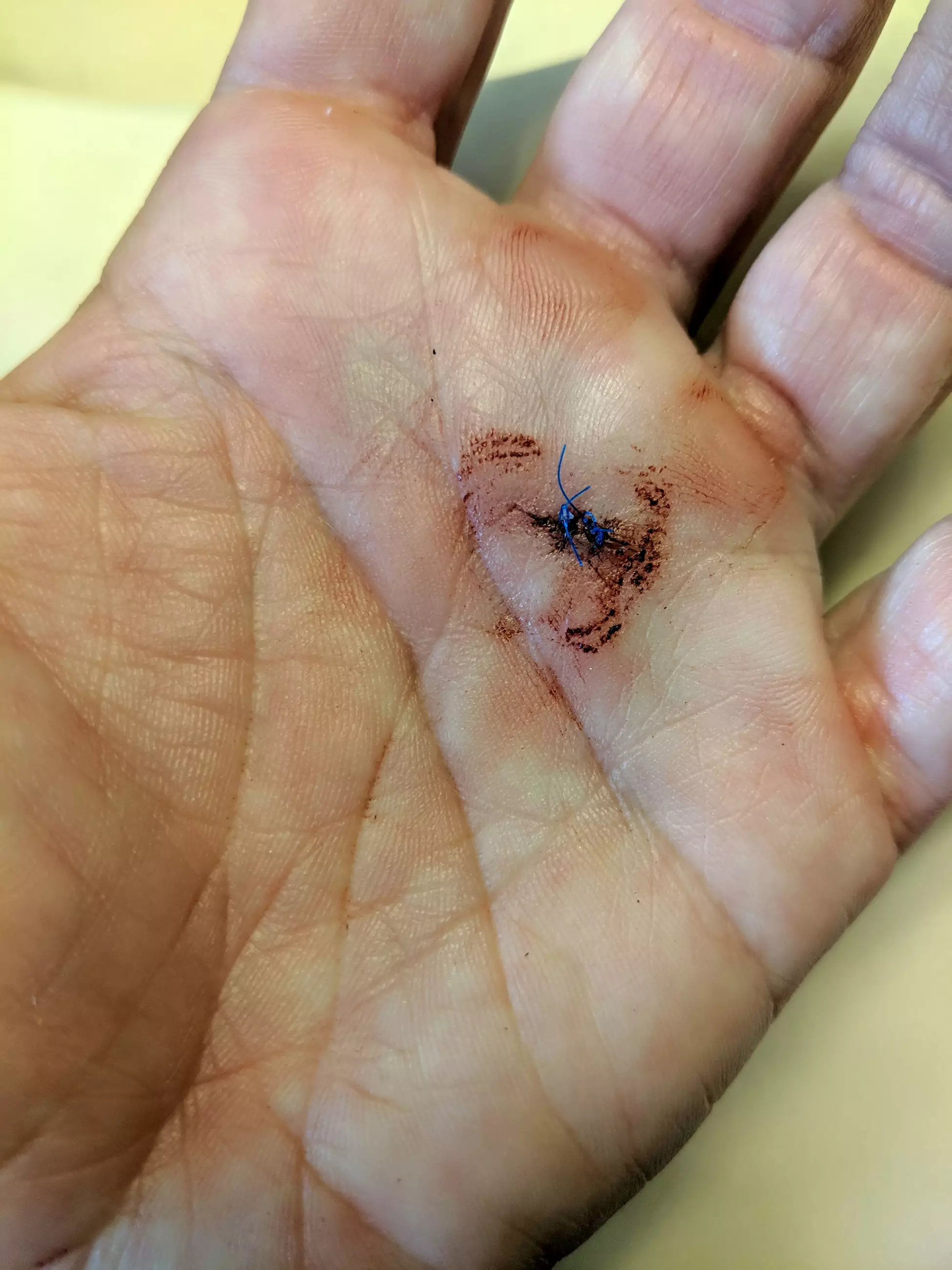 Melissa's hand scarred following surgery.