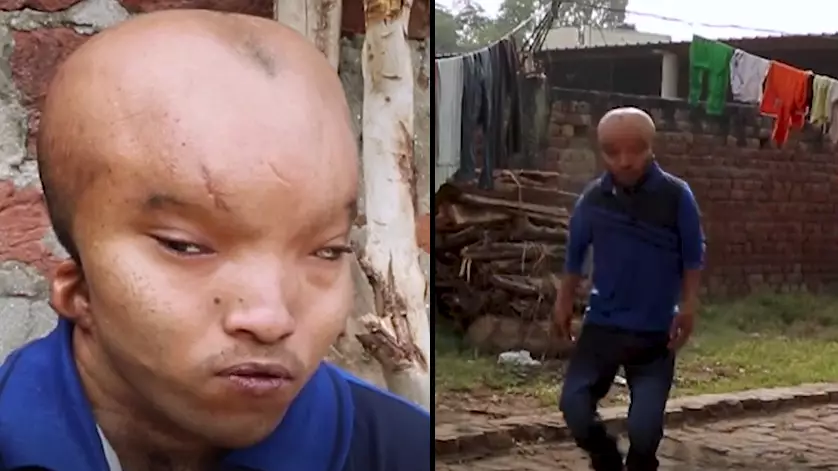 Man Given Cruel Nickname 'Alien' Hopes For Surgery So He Can Find Love 