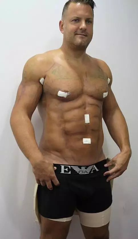 The procedure left him with the six-pack he always wanted.