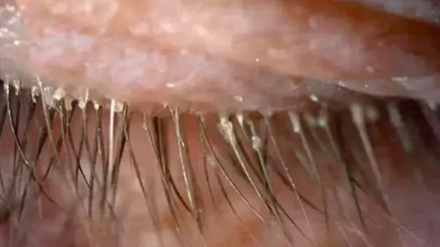 ​Women's 'Itchy Eyes' Caused By 100 Parasites Living In Her Eyelashes