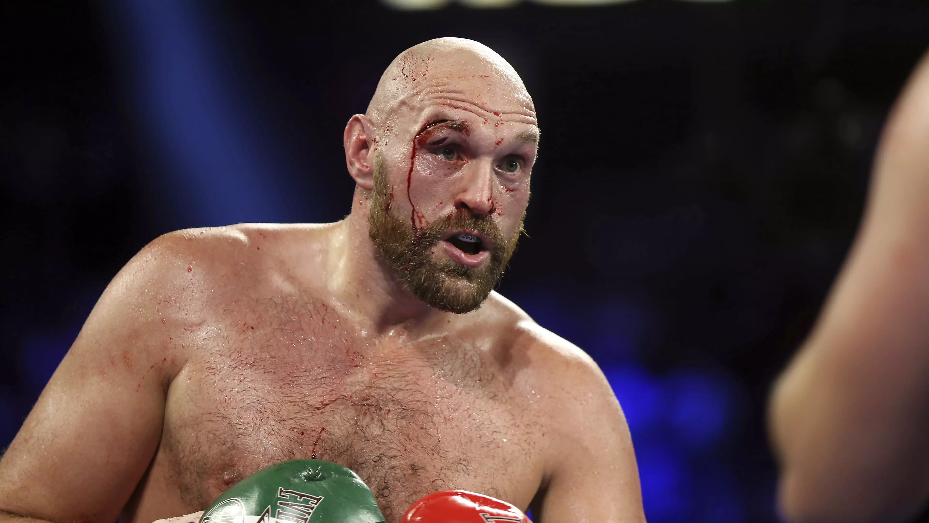 Tyson Fury could need plastic surgery to help heal his deep cuts