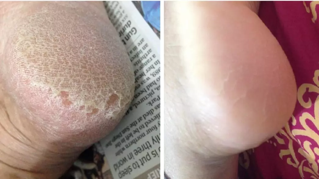People Are Crediting This £15 Hard Skin Remover With Giving Them Perfect Summer Feet