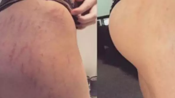Women Can't Stop Raving About Frank Body's Original Coffee Scrub In Dramatic 'Before And After' Pics