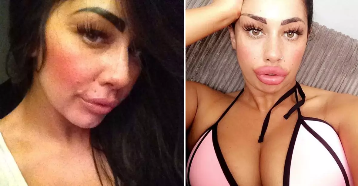 Woman Spends £1,625 On Lip Filler And Now She Wants Even Bigger Lips 