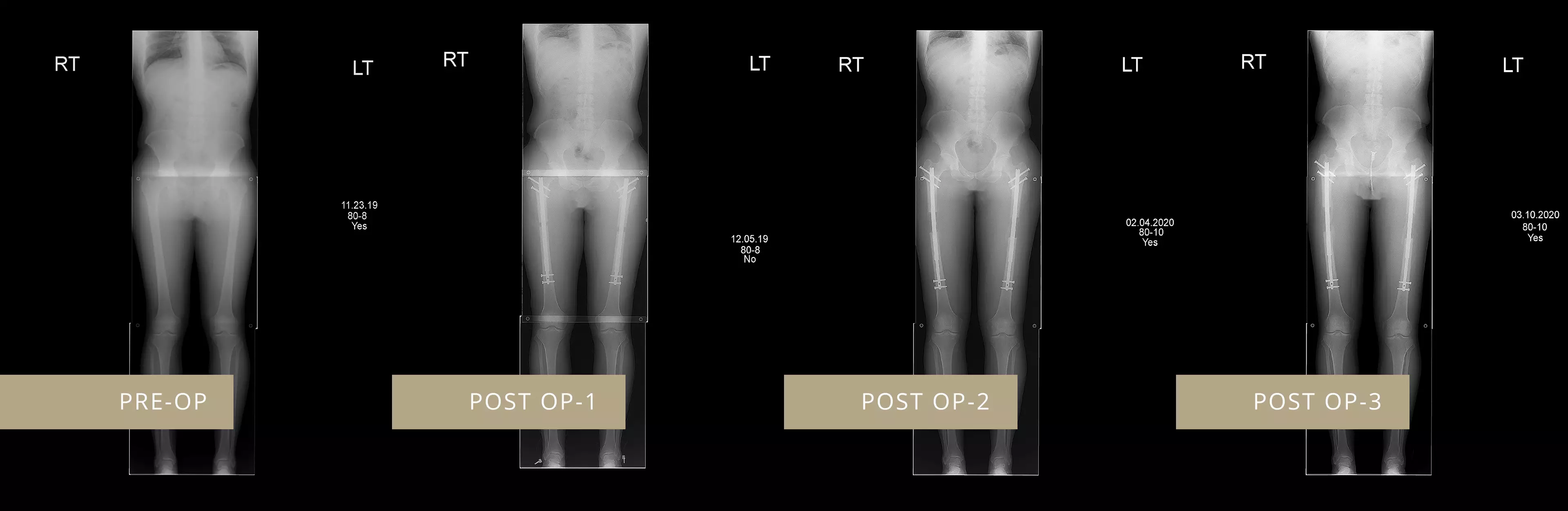 X-rays showing the procedure.