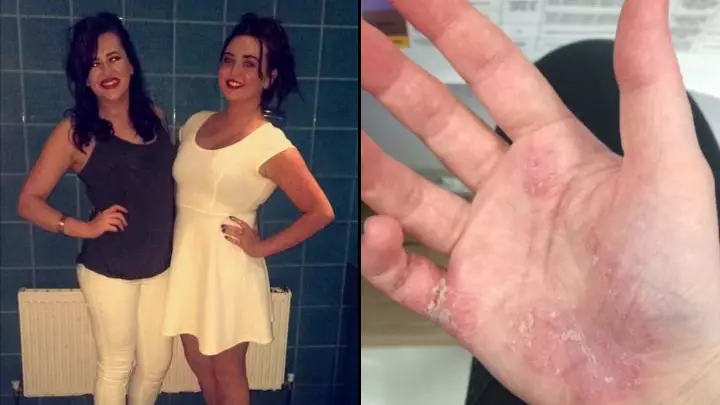 Woman's 'Eczema Cured In Two Weeks' After Being Advised To Give Up Dream Job