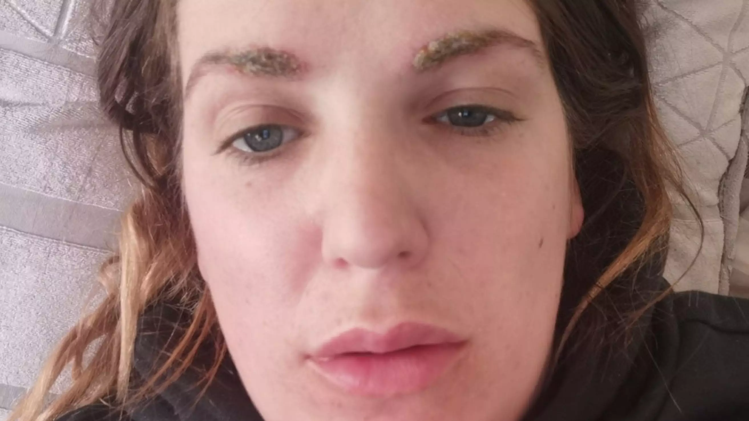 Salon Owner Who Forgot To Patch Test Left With 'Crusty Caterpillar' Brows Following Allergic Reaction