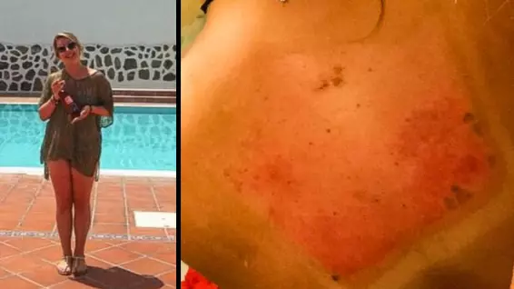 Woman Left With Back 'Like Pork Scratchings' After Horrendous Sun Burn