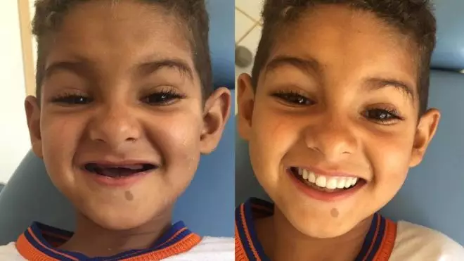 Boy From Brazil Gets New Set Of Teeth And He Can’t Stop Smiling About It
