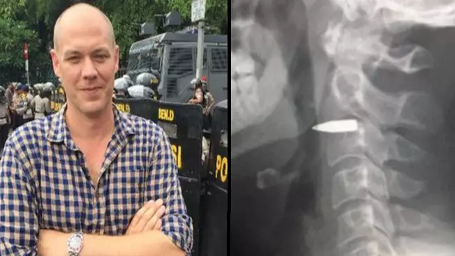 Journalist Shares Shocking Photo Of Bullet Lodged In His Neck