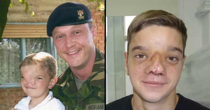 Incredible Transformation Of Bosnian Boy With Facial Deformity After Solider Helps Out