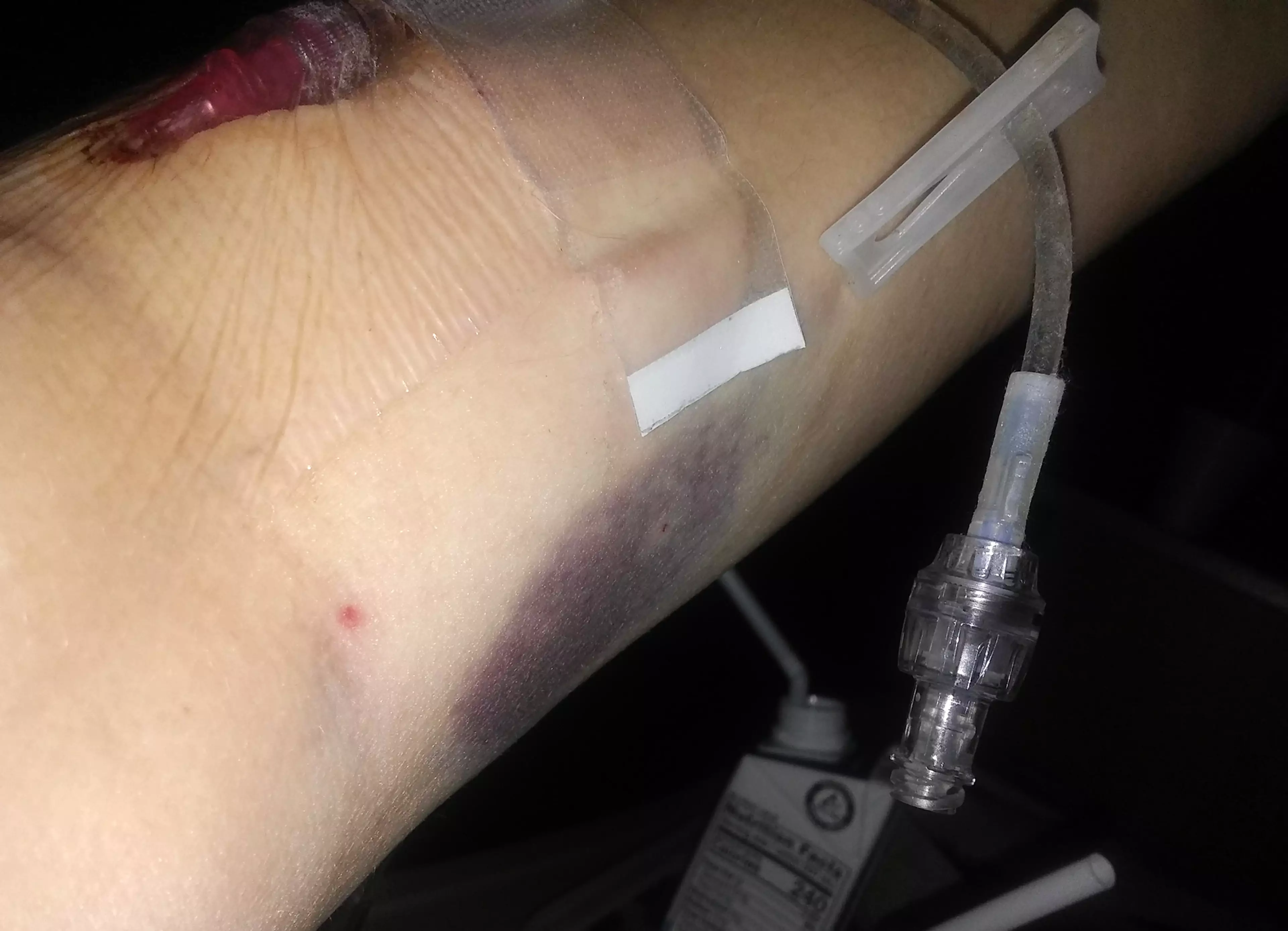 Jessica was hooked up to an IV machine for a week (