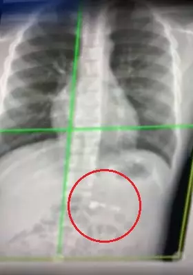 The x-ray shows the AirPod underneath his rib cage.