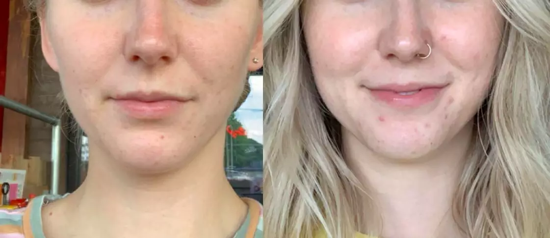 One acne-sufferer cleared up some mild acne on her cheeks with a benzoyl peroxide product.