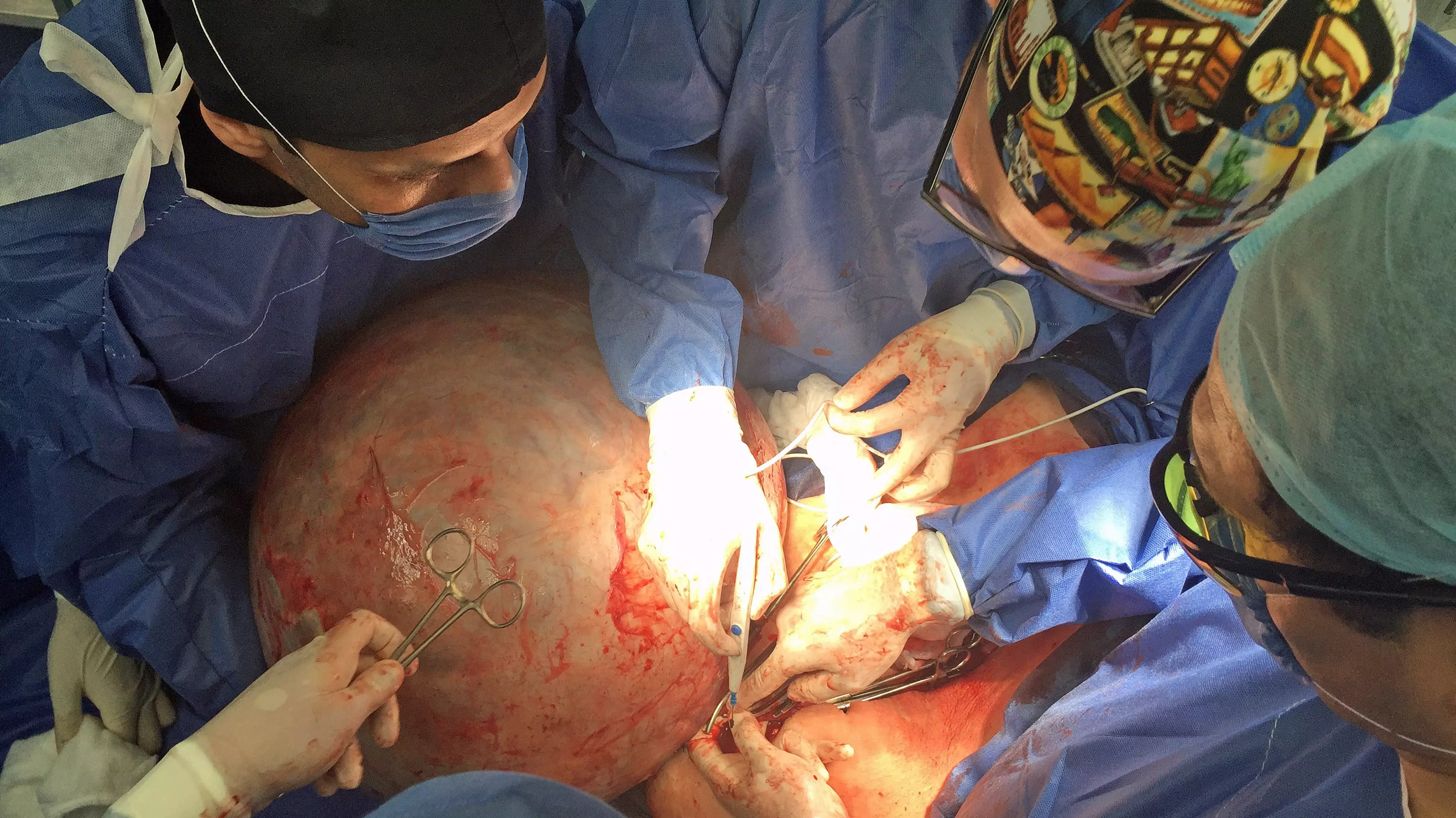 Video Shows Worlds Biggest Cyst Being Removed Saving Woman's Life