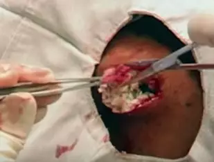 The Most Revolting Removal Of A Cyst In The History Of Time