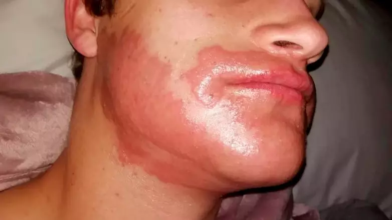 Man Suffers Severe Allergic Reaction After His Girlfriend Persuades Him To Dye His Beard
