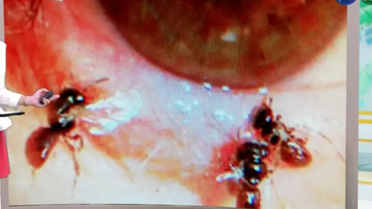 Doctors Find Four Live Bees Feeding On Tears Inside Woman's Eye