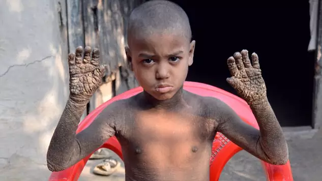 Boy Suffering From Horrific Skin Condition Makes Stunning Recovery