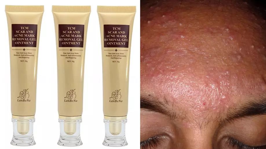 The Internet Can't Get Enough Of This £3 'Miracle' Acne Cream
